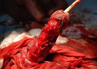 Penis lengthening operation